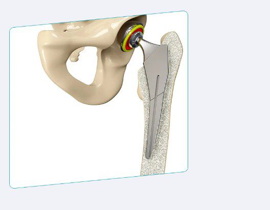 Современные хирургические методики восстановления тазобедренного сустава 1 2